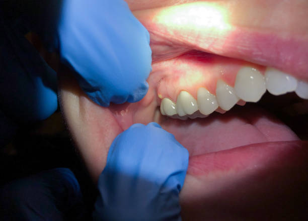 Best Dentist for Tooth Abscess  in Punaluu, HI
